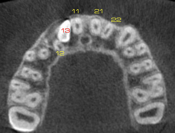 CBCT